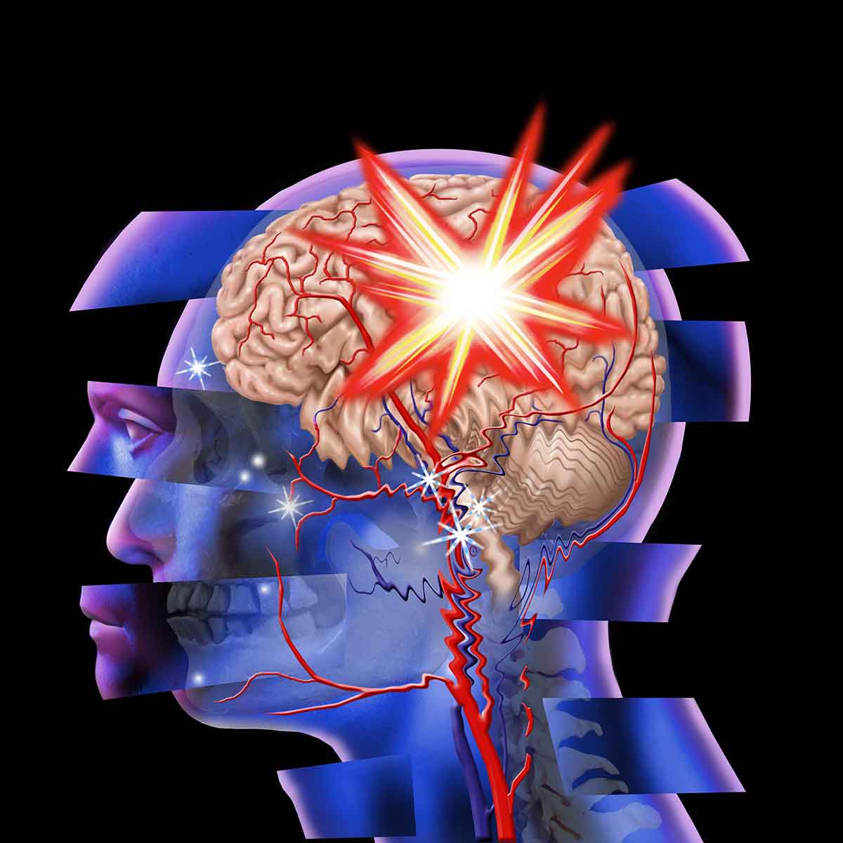 graphical image of a brain injury - traumatic brain injury and drug abuse - victory addiction recovery center - trending topics